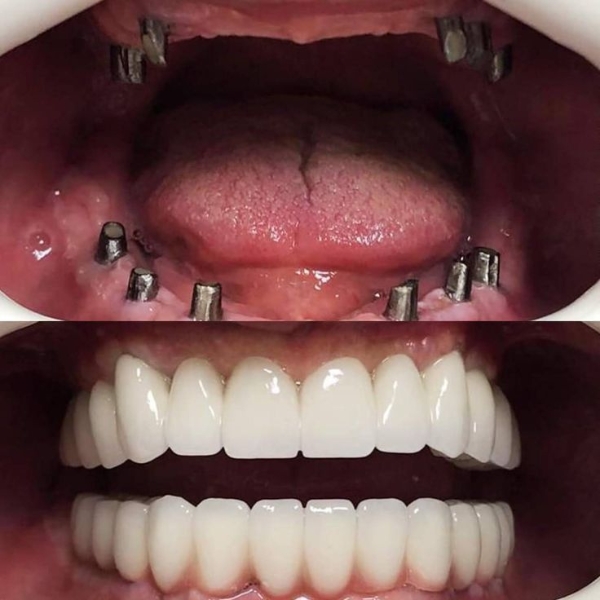 before after implant 2