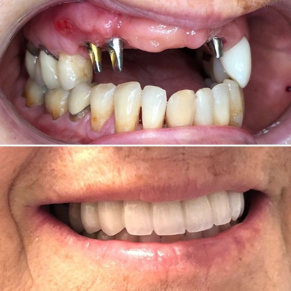 before after implant