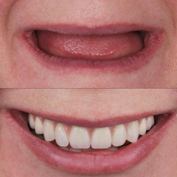 implant 3