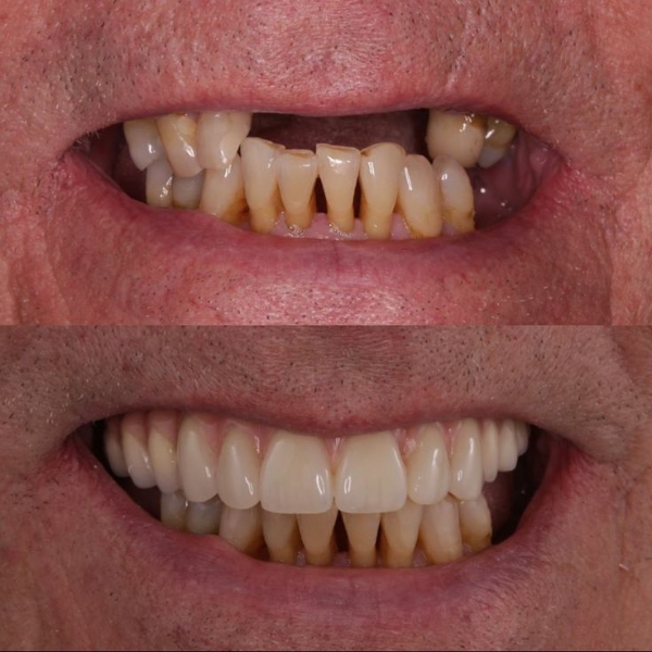implant 4