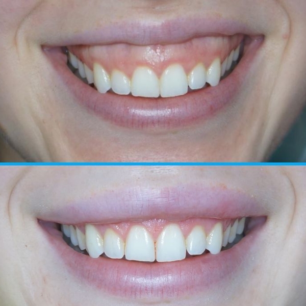 Gum surgery3