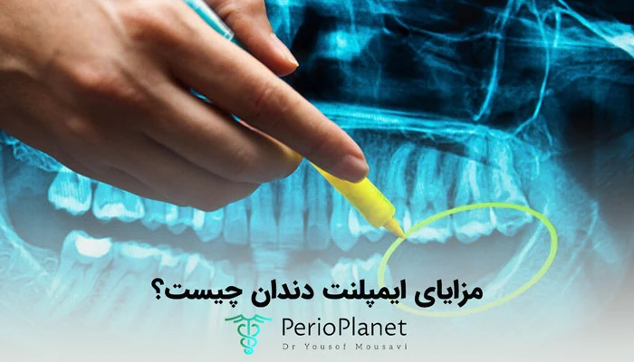 فواید ایمپلنت