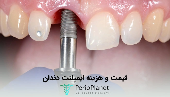 تعرفه و قیمت هر واحد ایمپلنت دندان چقدر است؟