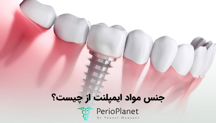 ایمپلنت دندان تیتانیوم بهتر است یا زیرکونیایی؟
