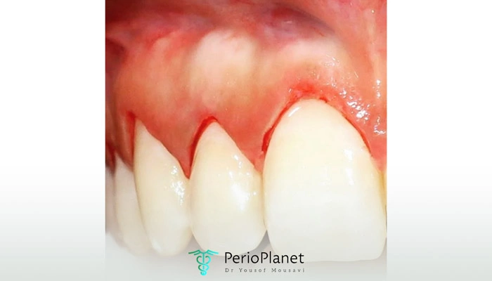 مزایای لیفت لثه