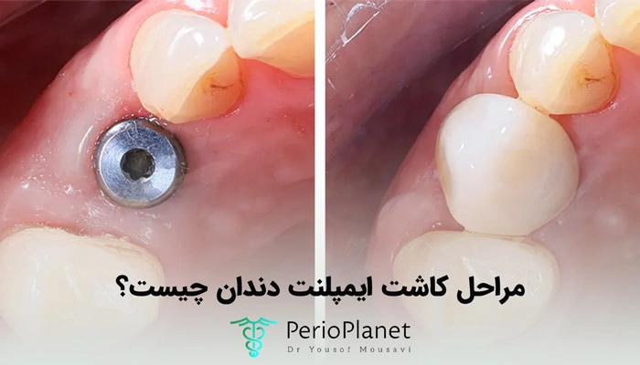 مراحل کاشت ایمپلنت دندان