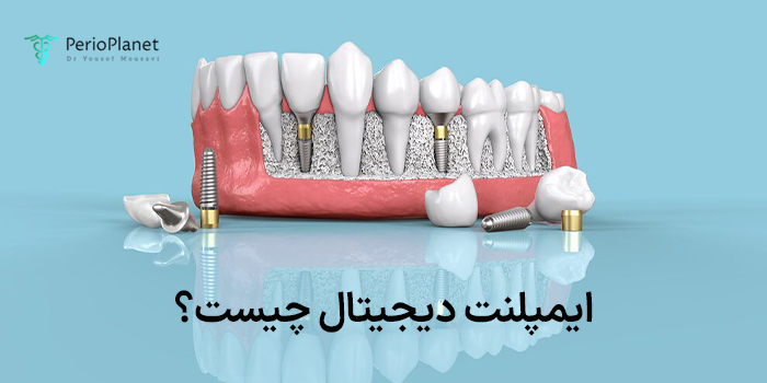 ایمپلنت دیجیتال