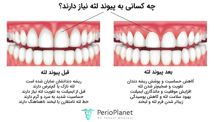 اینفوگرافیک درباره کاندیدا و مزایای پیوند لثه