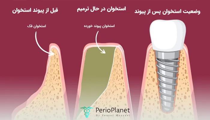 ایمپلنت بعد از پیوند استخوان