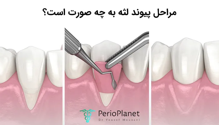 مراحل پیوند و بازسازی لثه