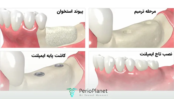 مراحل پیوند استخوان برای ایمپلنت دندان