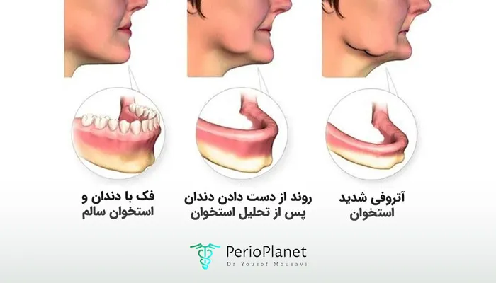 تفاوت استخوان تحلیل رفته و فک سالم