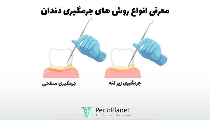 روش های جرم گیری دندان