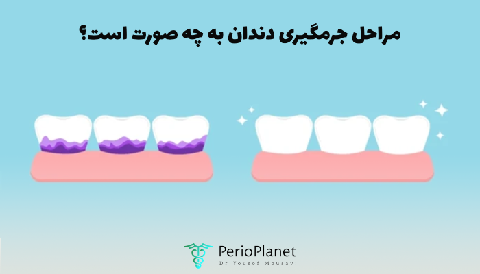 مراحل جرم گیری دندان چیست؟