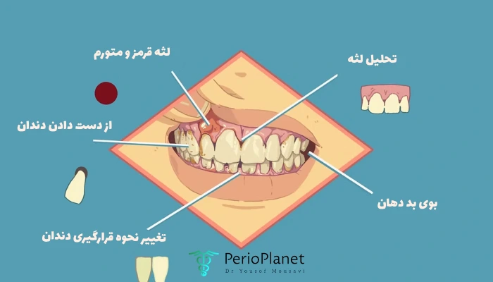 علائم بیماری لثه