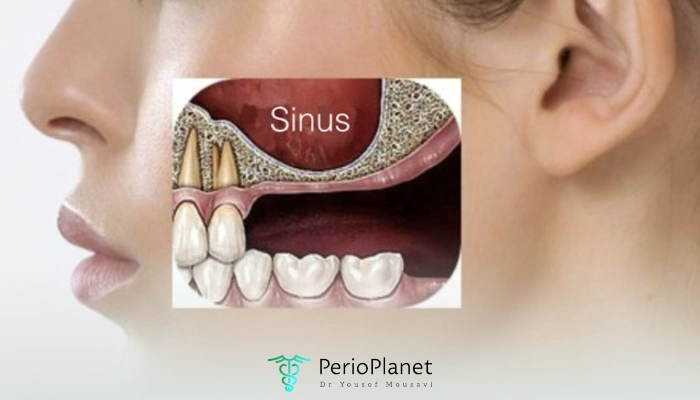 لیفت سینوس چیست؟ سینوس در کجا قرار دارد؟