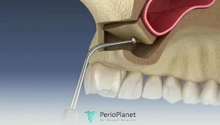 چه زمانی باید لیفت سینوس را انجام داد؟