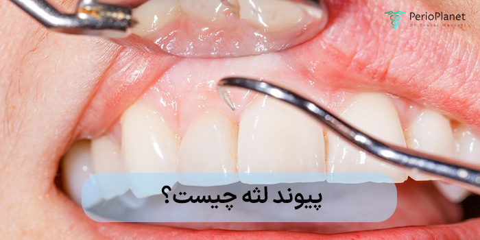 پیوند لثه چیست؟ کاملترین راهنمای درمان تحلیل لثه