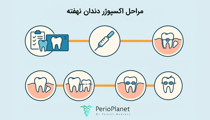 مراحل اکسپوژر دندان نهفته