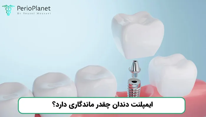 طول عمر ایمپلنت دندان چقدر است؟