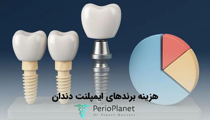 مقایسه برندهای ایمپلنت موجود در کلینیک تهران ایمپلنت