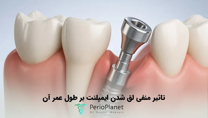 علائمی که نشان میدهد طول عمر ایمپلنت در خطر است