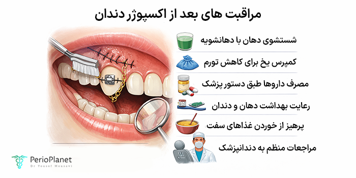 مراقبتهای بعد از اکسپوژر دندان نهفته