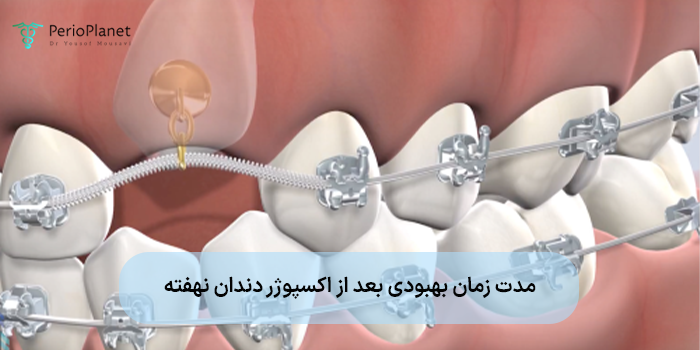 مدت زمان بهبودی بعد از اکسپوژر دندان نهفته
