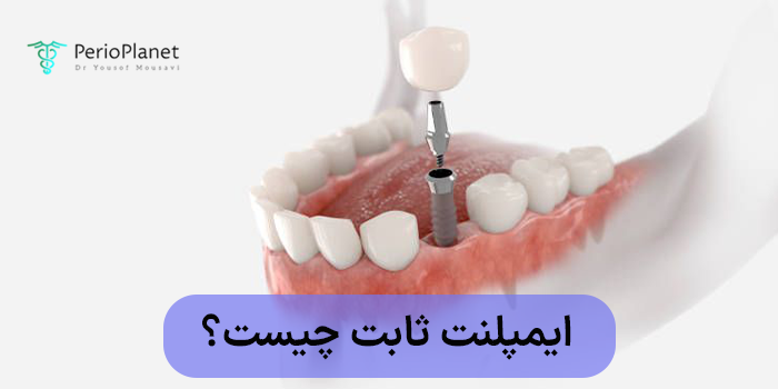 ایمپلنت ثابت