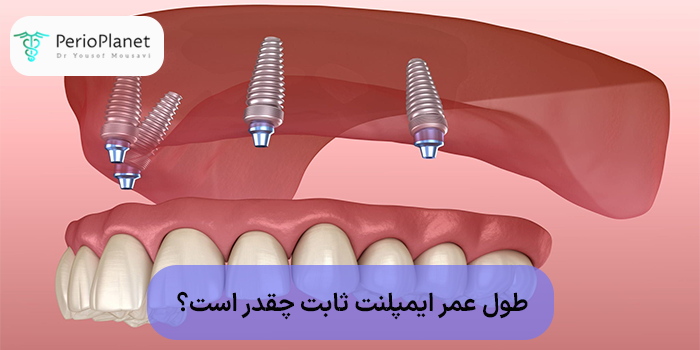 طول عمر ایمپلنت ثابت چقدر است؟