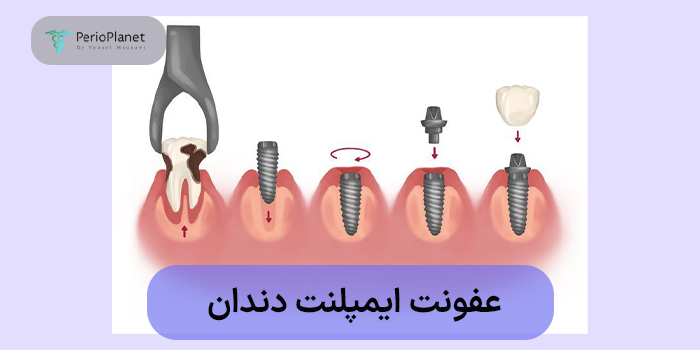 عفونت ایمپلنت دندان