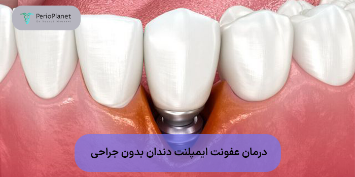 درمان عفونت ایمپلنت دندان بدون جراحی